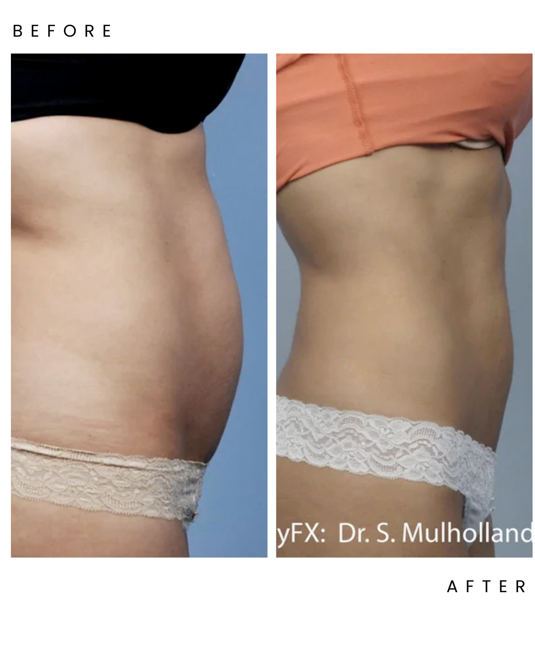Cellulite & Body Contouring in Cambridge, ON — Mimada Beauty